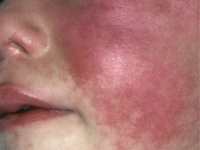 scarlet fever  face rash