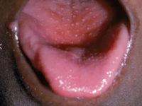 scarlet fever throat symptoms
