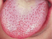 scarlet fever tongue symptoms